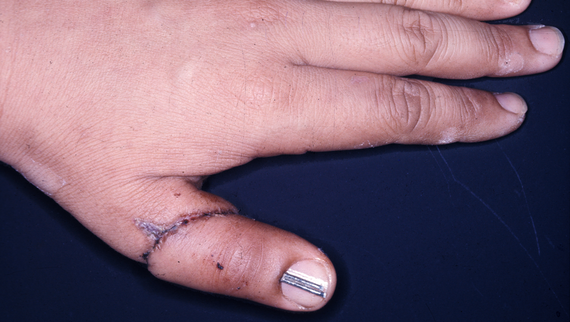Hong Kong's first microsurgical thumb replant